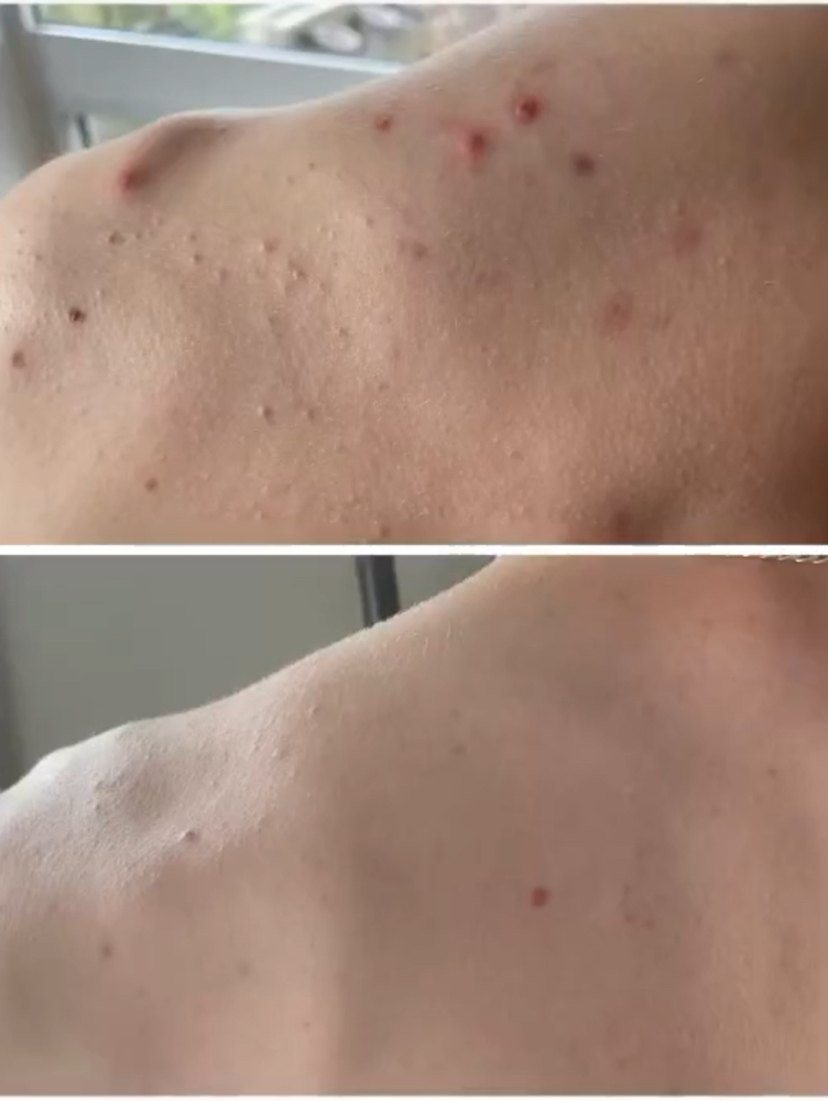 Celluma light therapy (back or chest)