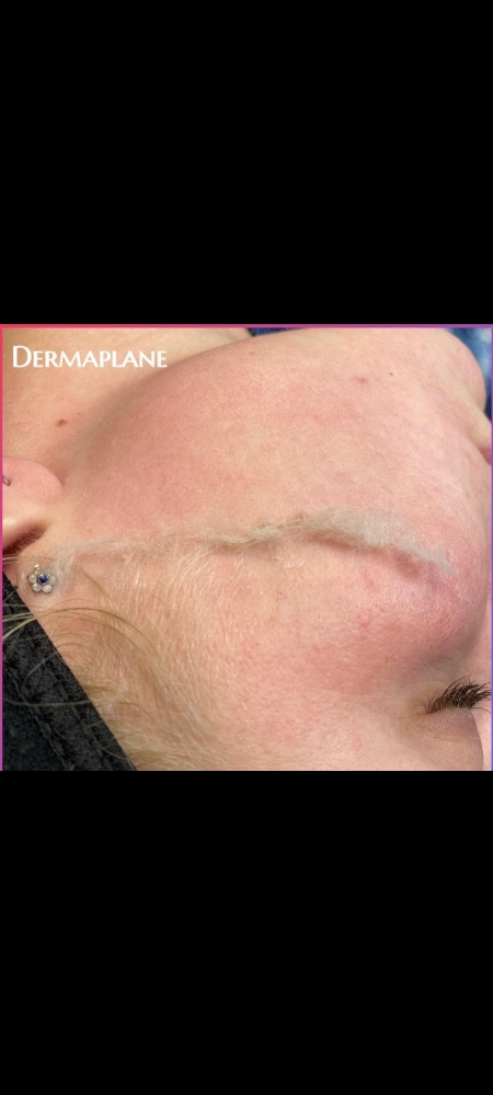 Custom Dermaplane Facial