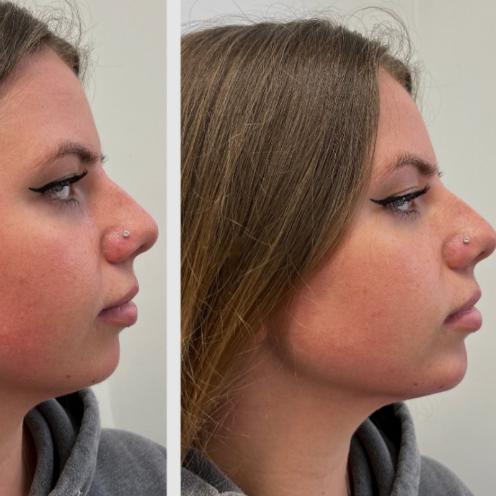 Chin FILLER ✨ at Boujee Asthetics ✨ in Tucson, AZ