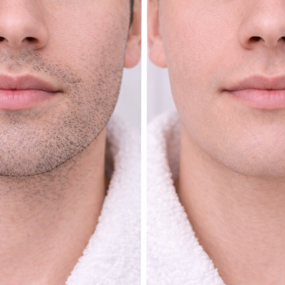 Full Face Laser Hair Removal