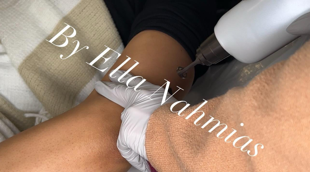 Laser Tattoo Removal
