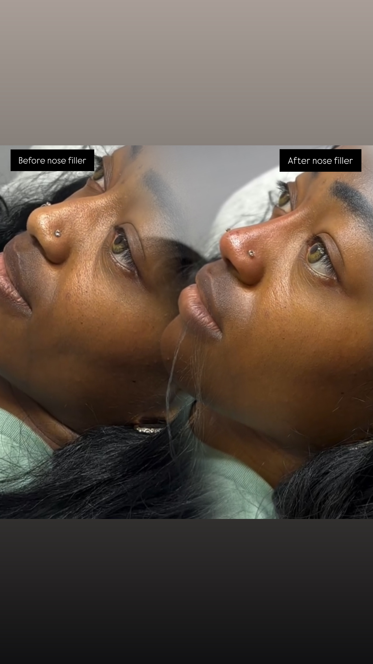 1ml needleless nose filler