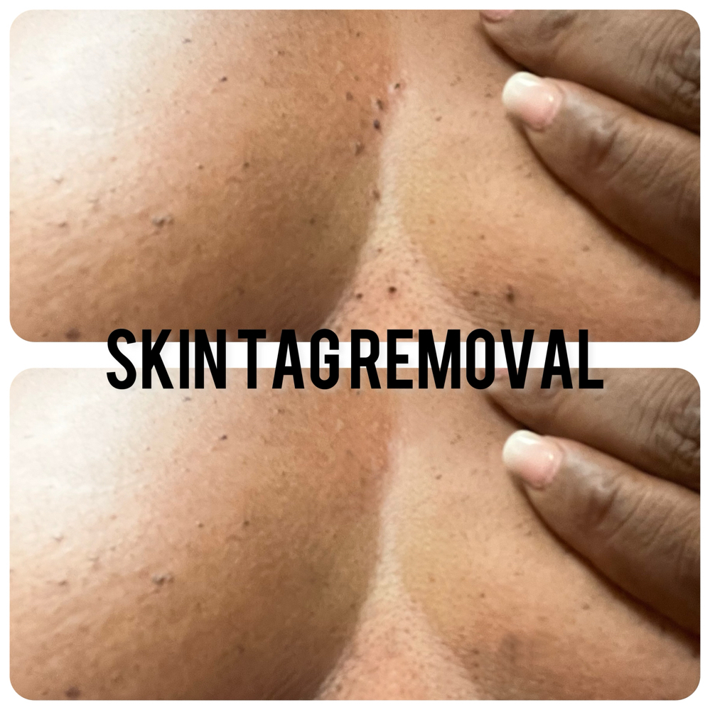 Skin Tag And Mole Removal