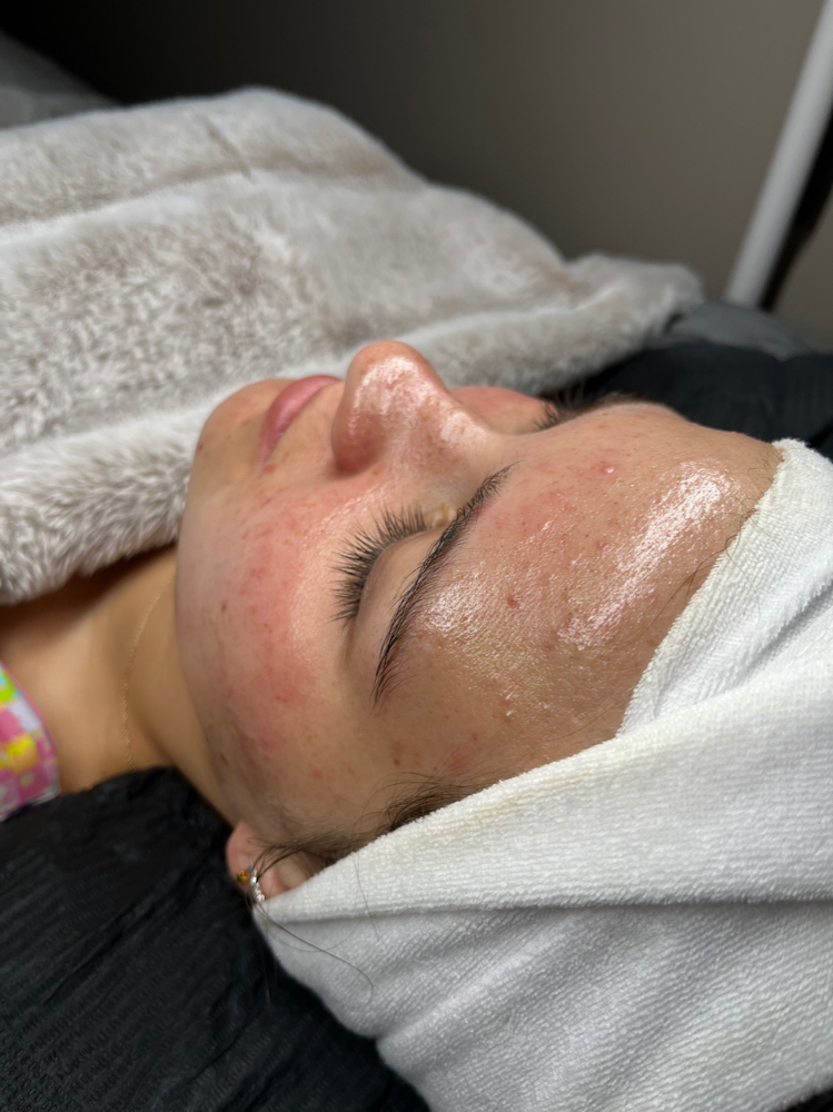 Oxygen Infusion Facial
