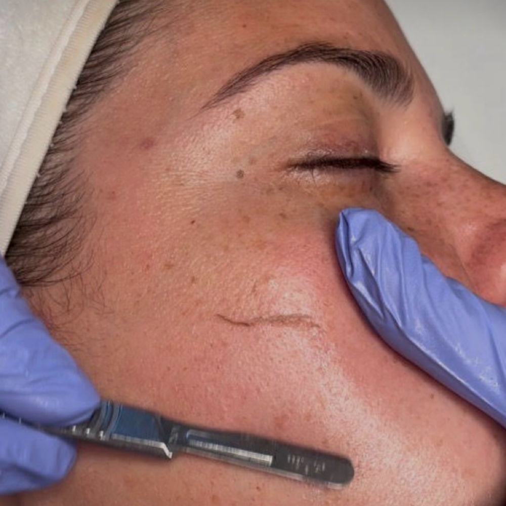 Dermaplaning at Graceful Skin Aesthetics LLC in Glendale, AZ