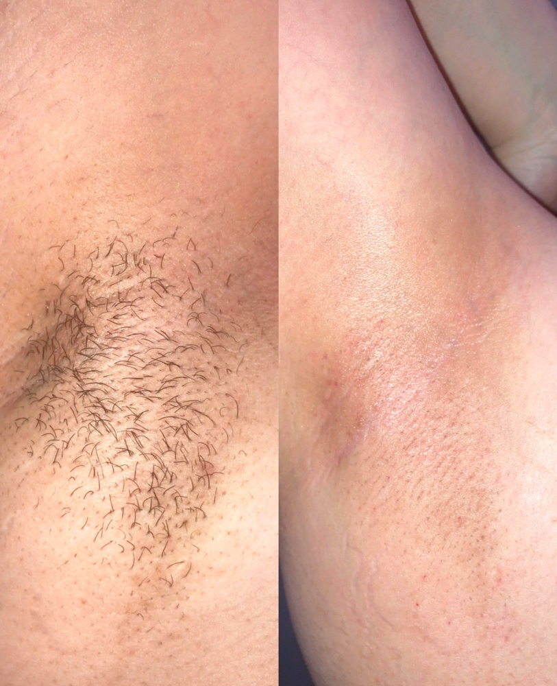 Brighting Underarm Treatment
