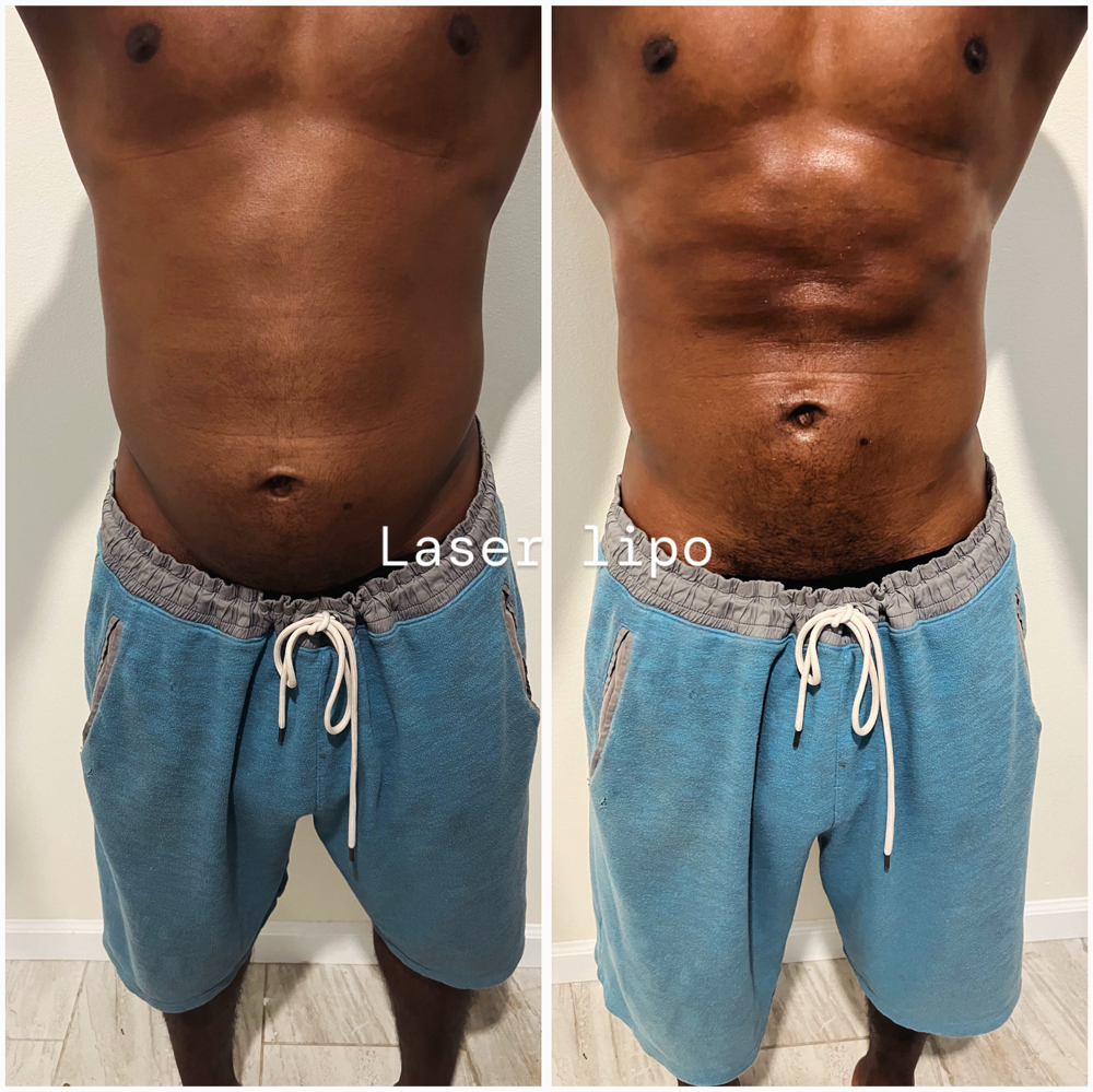 Waist Lipo