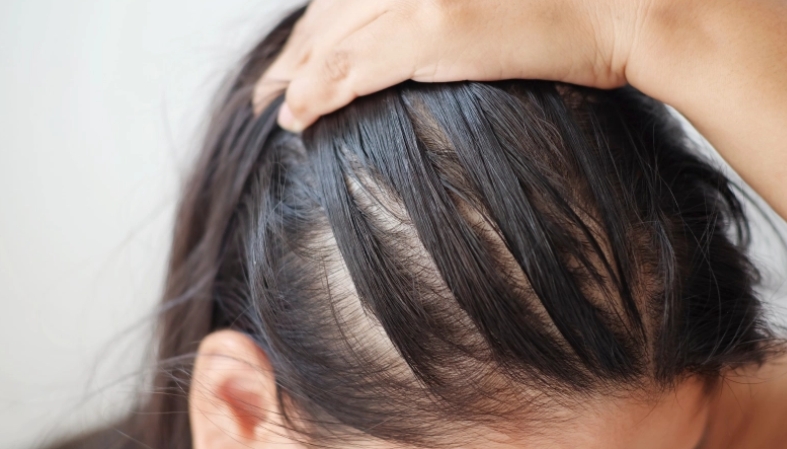 Hair Loss Treatment