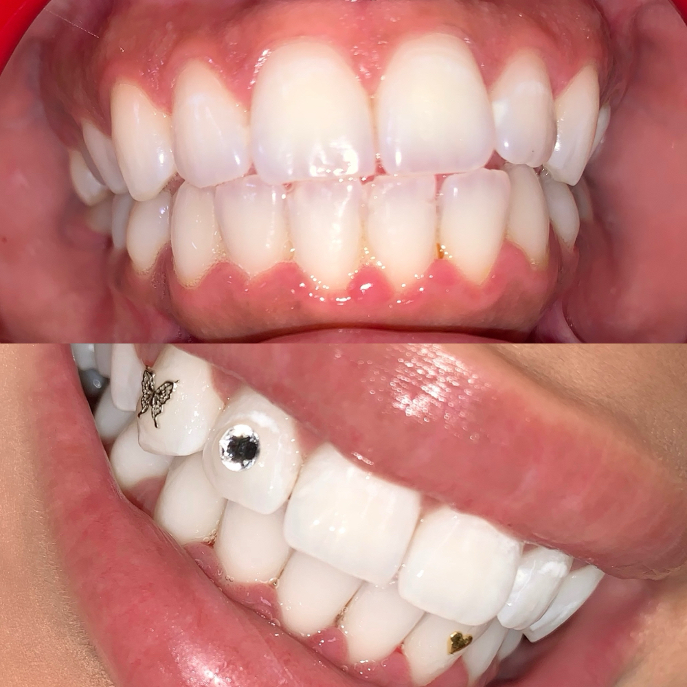 BUTTERFLY 3.0ᴺᴶ #Tropical at MONMOUTH COUNTYᴺᴶ ✧ 1ST TOOTH JEWELER ↯ #POPURWAXINCHERRY in Hazlet, NJ