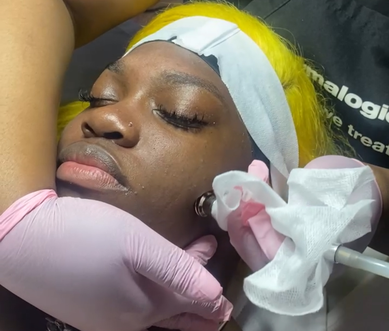 Microdermabrasion Facial