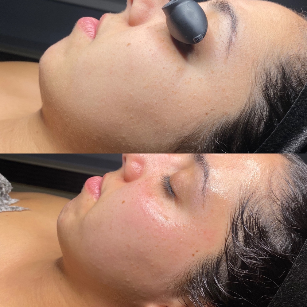 Custom Facial