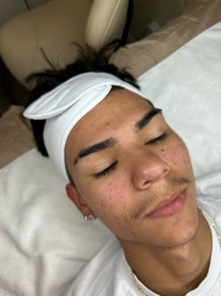 Add On Chemical Peel