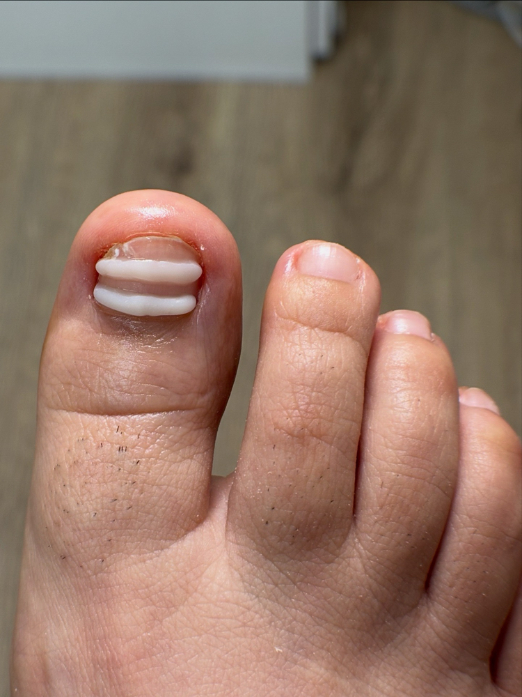 Ingrown Toenail Relief- 1 Toe at Pure Nail Studio in Port Hueneme, CA