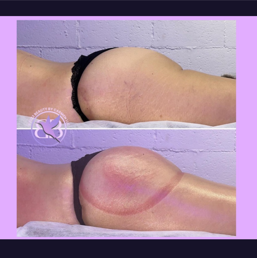 Body Sculpting & Butt Lift