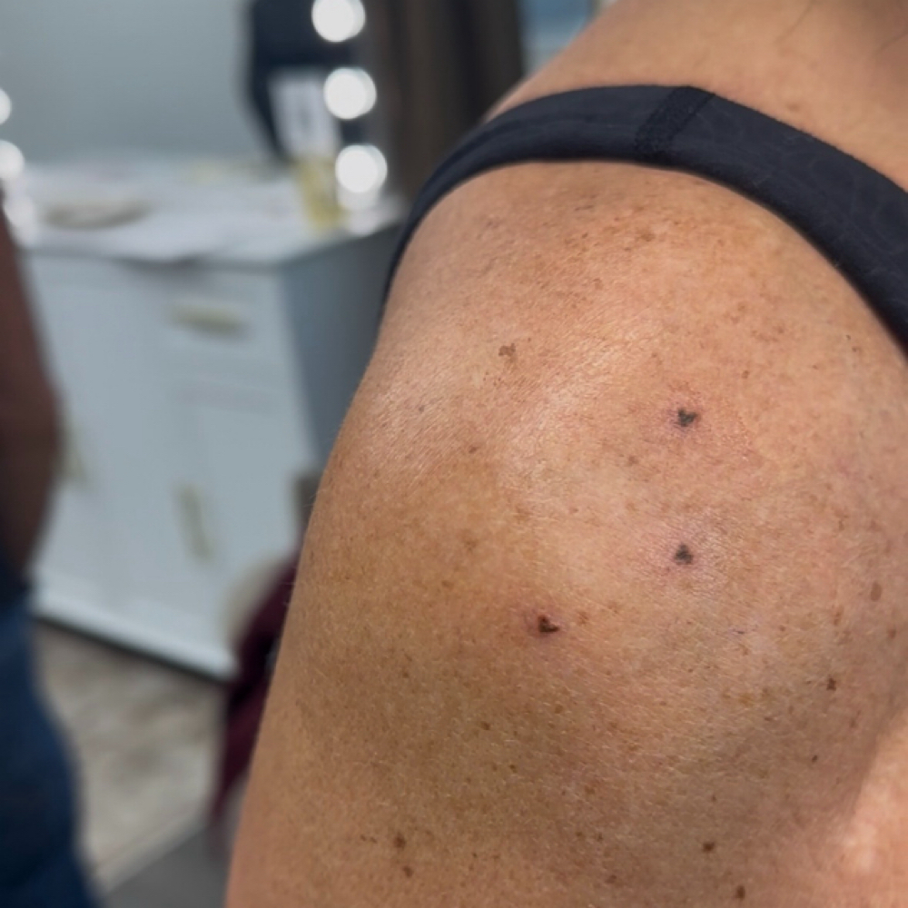 Custom Freckles at Katelyn Kosmetic in Boise, ID