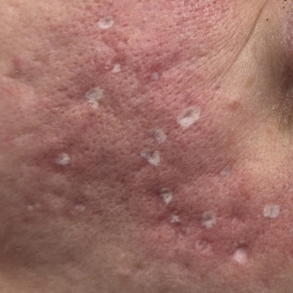 TCA CROSS | Acne Scarring at Arcana Med Spa in Castle Rock, CO