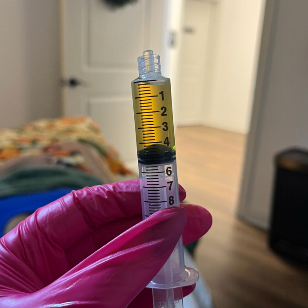 PRP Microneedling at Genesis Health and Beauty Bar in Daphne, AL