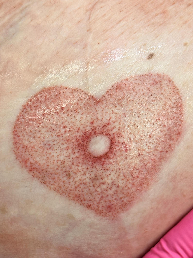 Areola Restoration Tattoo