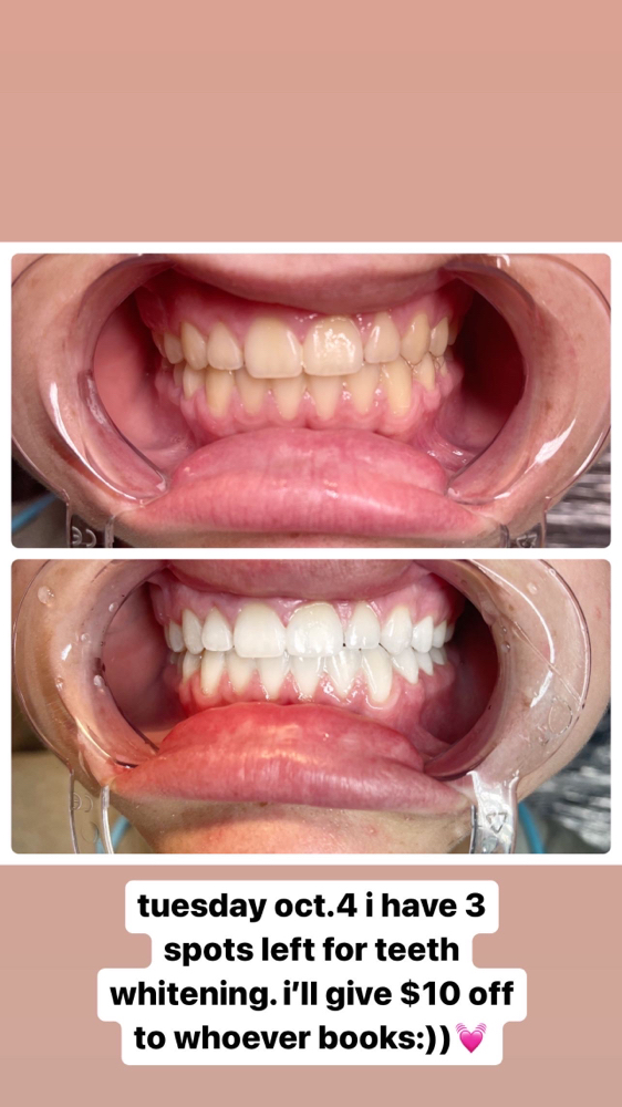 Teeth Whitening 1 Session