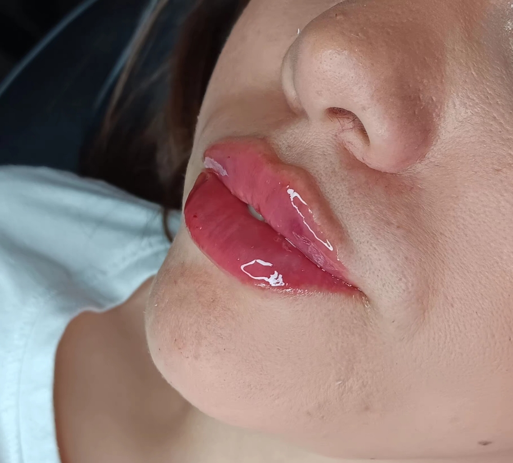 .9ML Russian Technique (Model)