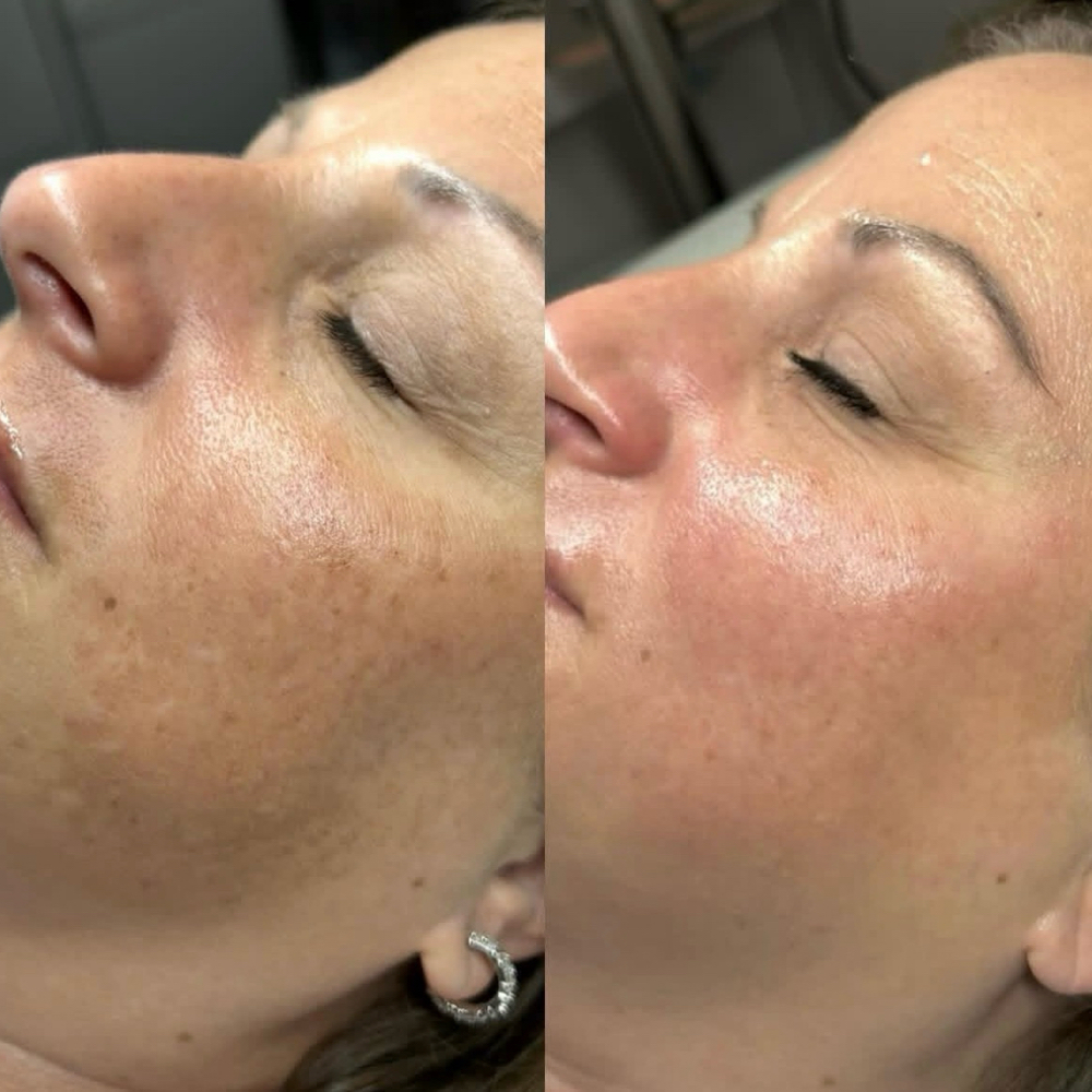 Lightening Lift  Peel at RHS Esthetics in Booneville, MS