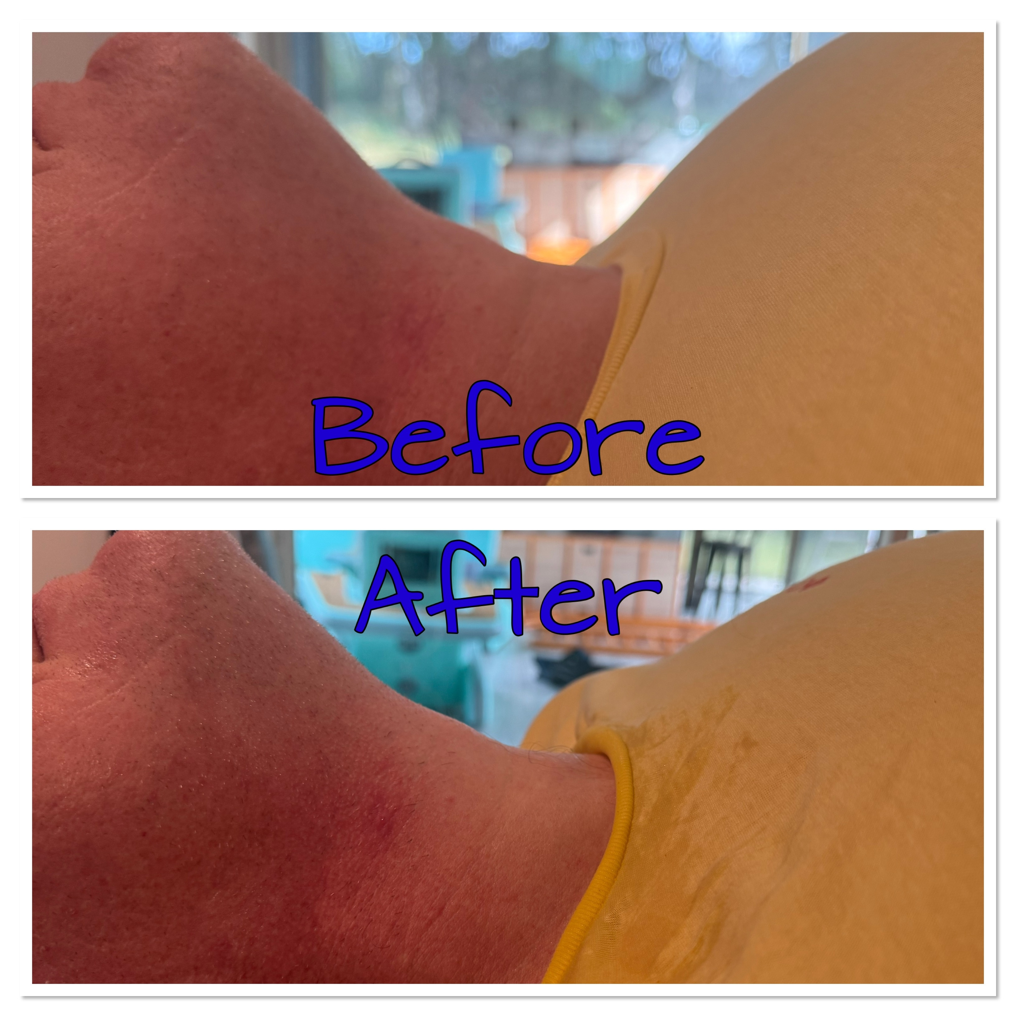 Facial Skin Tightening 1-Session