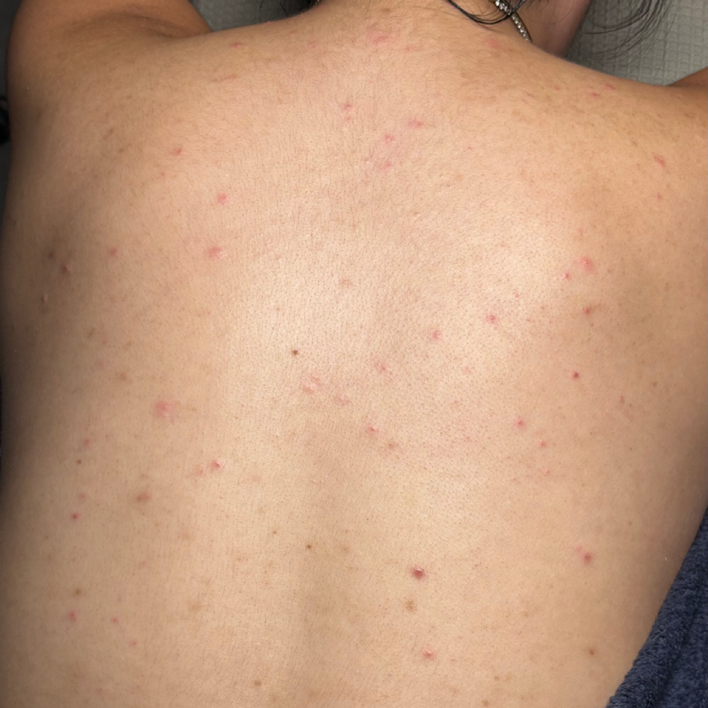 Back facial at Zbeautycare in Yuma, AZ