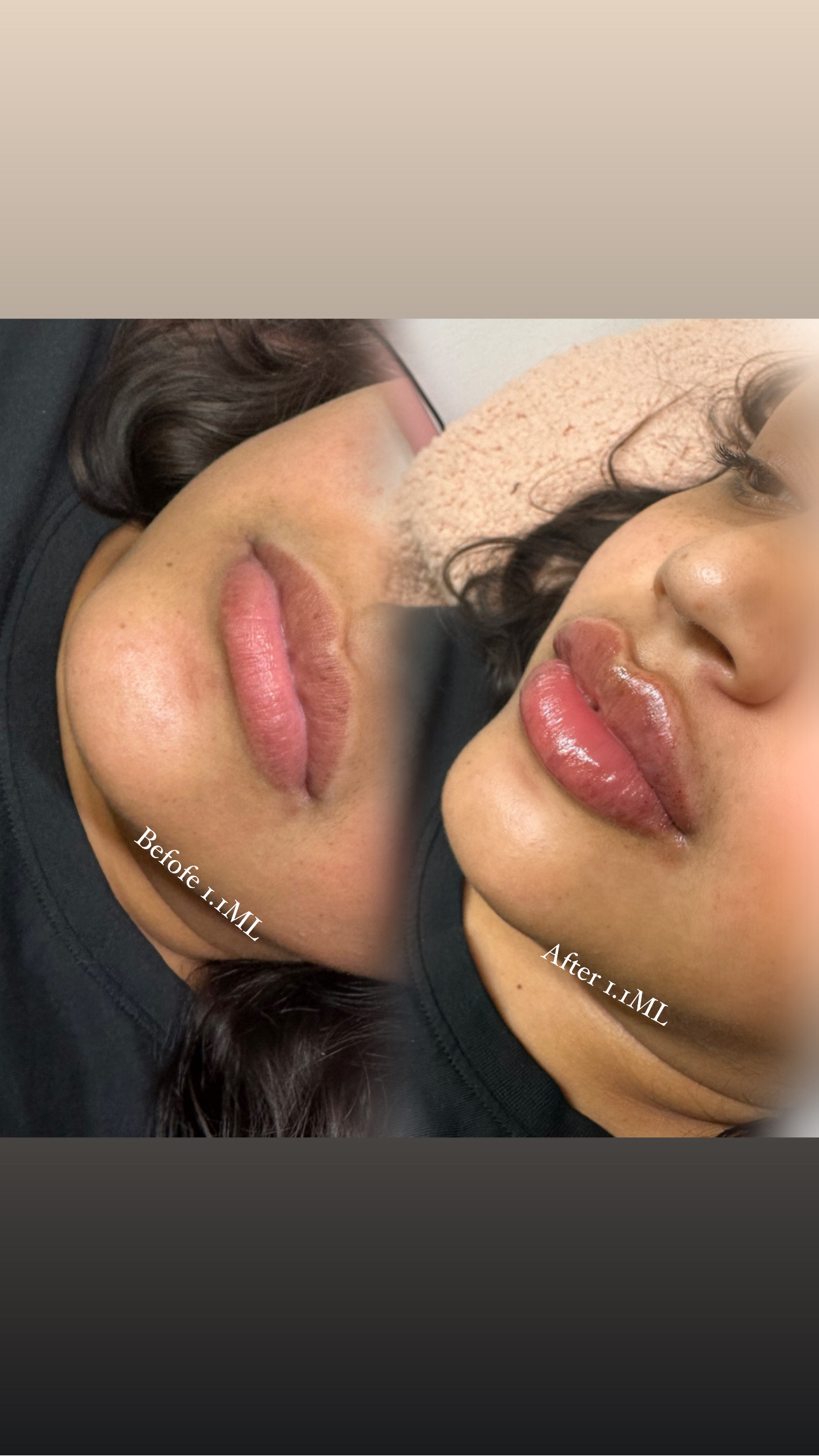 Needleless 1.5ml lip filler