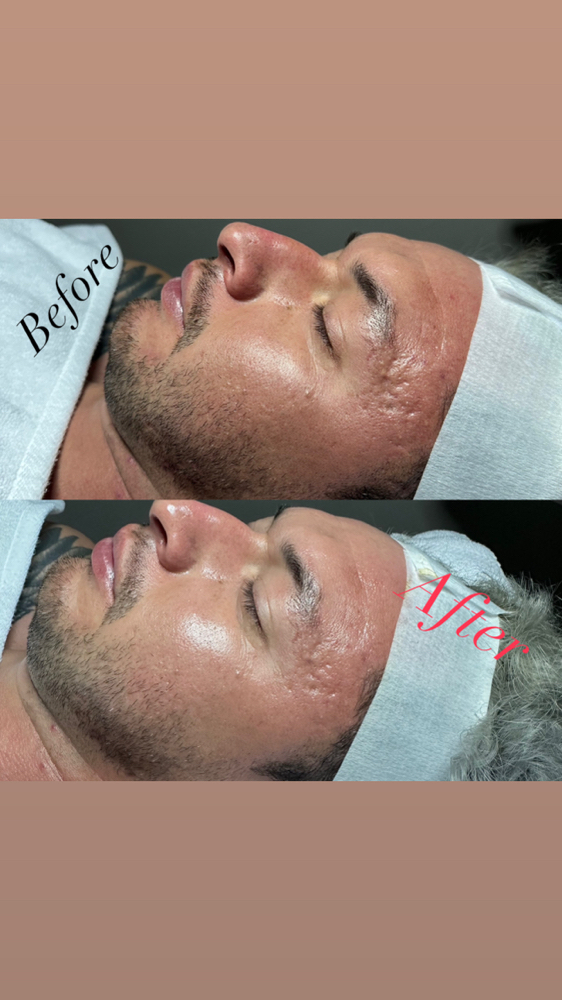 Microneedling