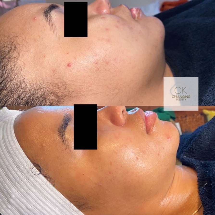 Customized Facial