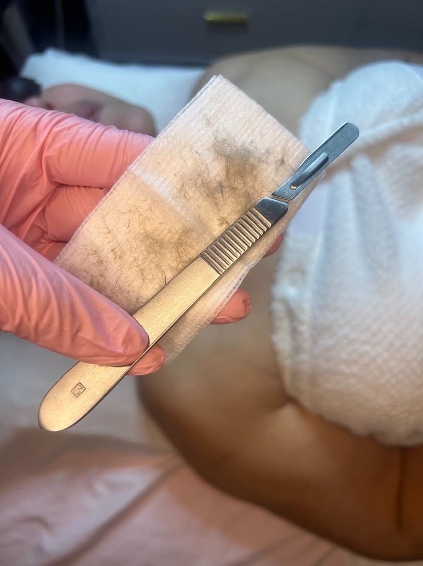 Dermaplaning Add On