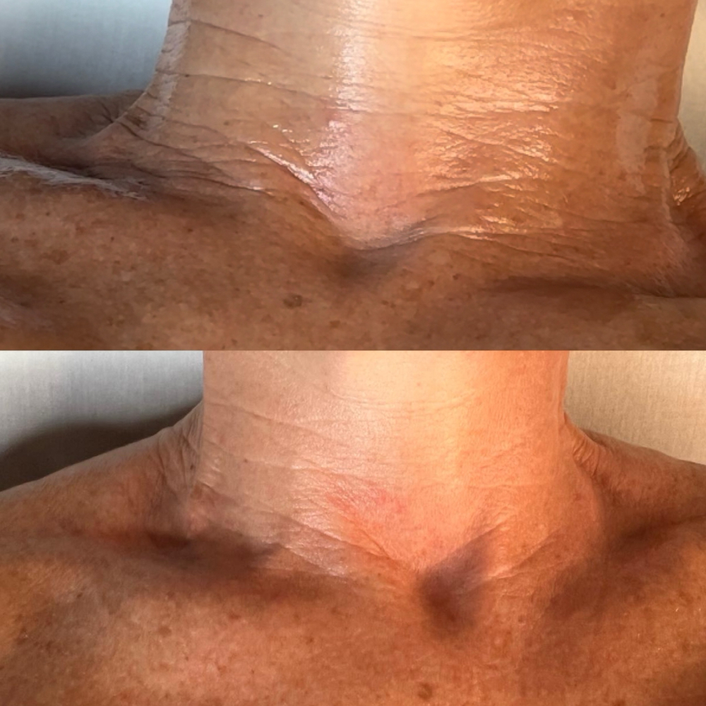 Firming Peptides Facial With Dermap