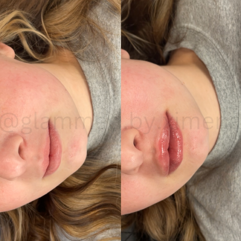 Hyapen LipFiller at Glammed by Ximena in Midland TX, TX