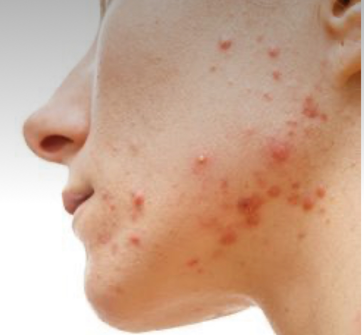 Clear Skin Facial