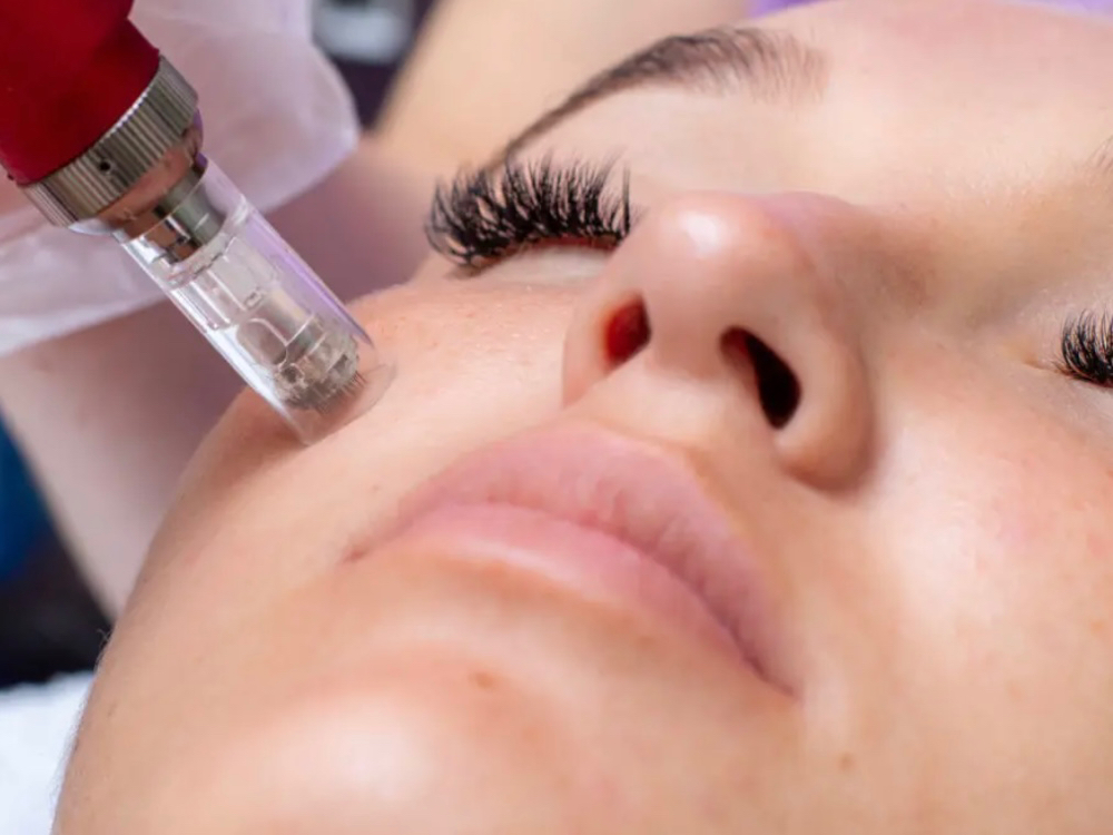 Microneedling Treatment