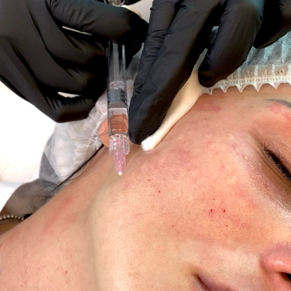 PDRN Skin Boosters at Latina Body Contour Spa in Dallas, TX
