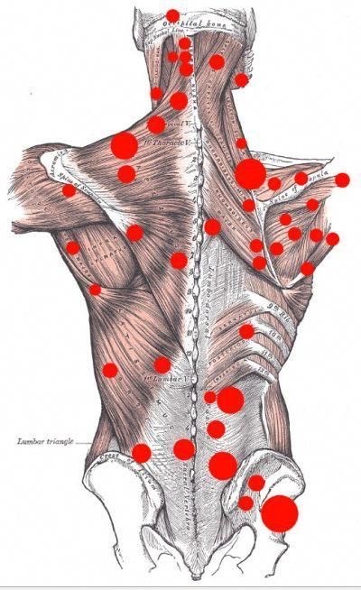 Trigger Point Therapy