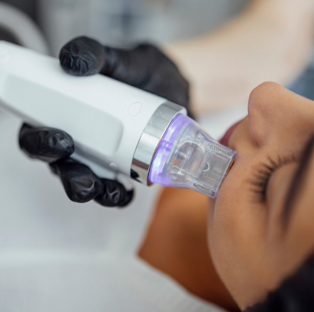 RF Facial- Skin Tightening