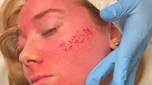 Micro-needling facial