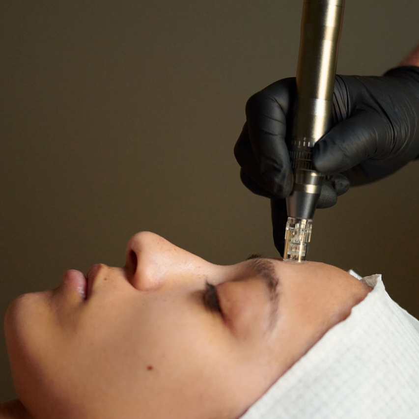 Nano Precision Refinement at Dew+Glow Aesthetics in Snellville, GA
