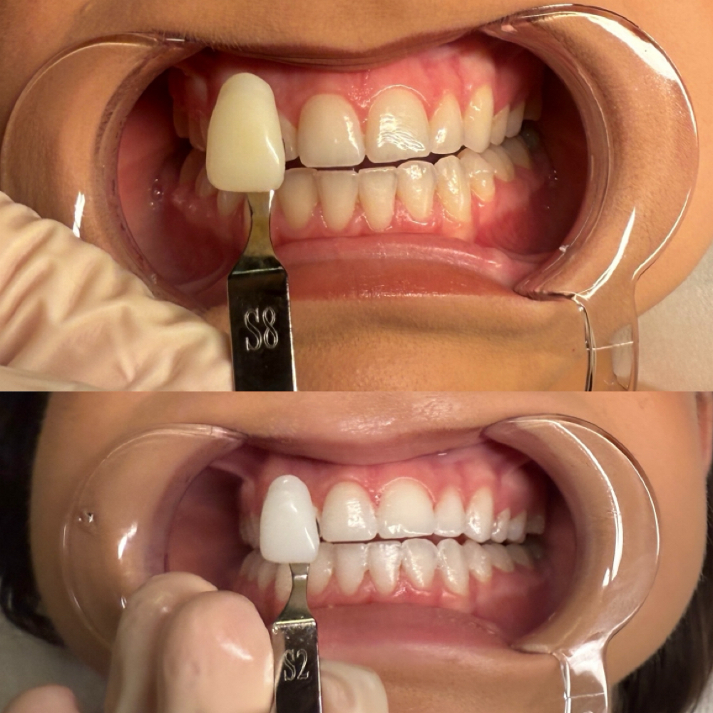 Teeth Whitening at MySkin Aesthetics in Laredo, TX
