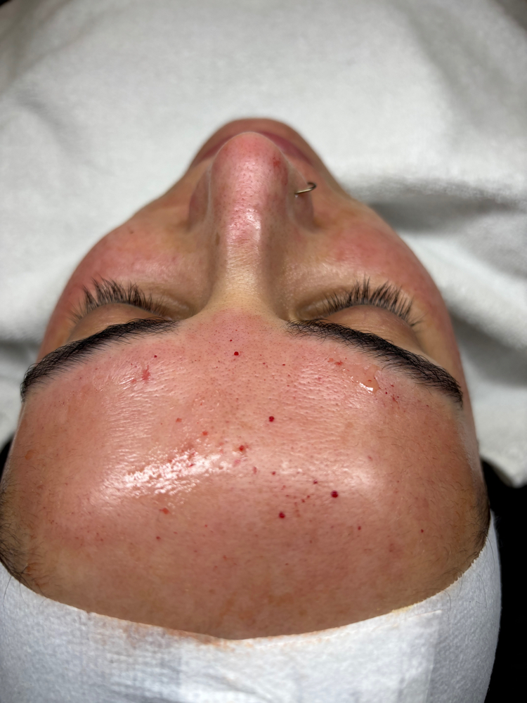 Microneedling Treatment