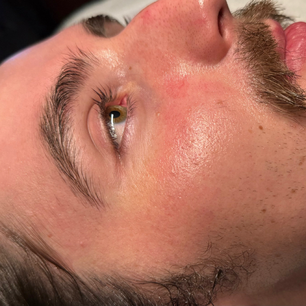 Refine & Renew Peel - Lv 2