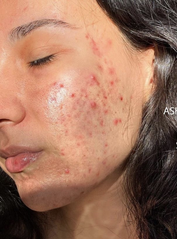 Acne Bootcamp Initial Appointment