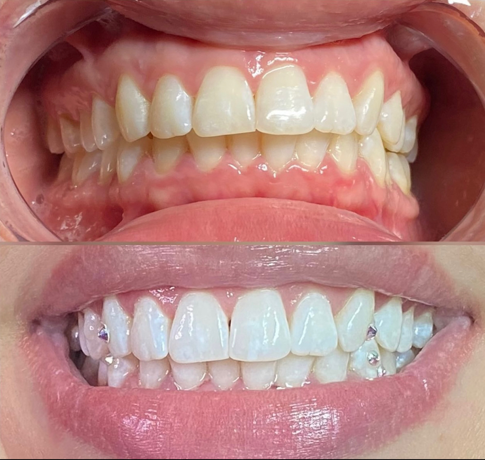 Teeth Whitening & Tooth Gem 1 Hour