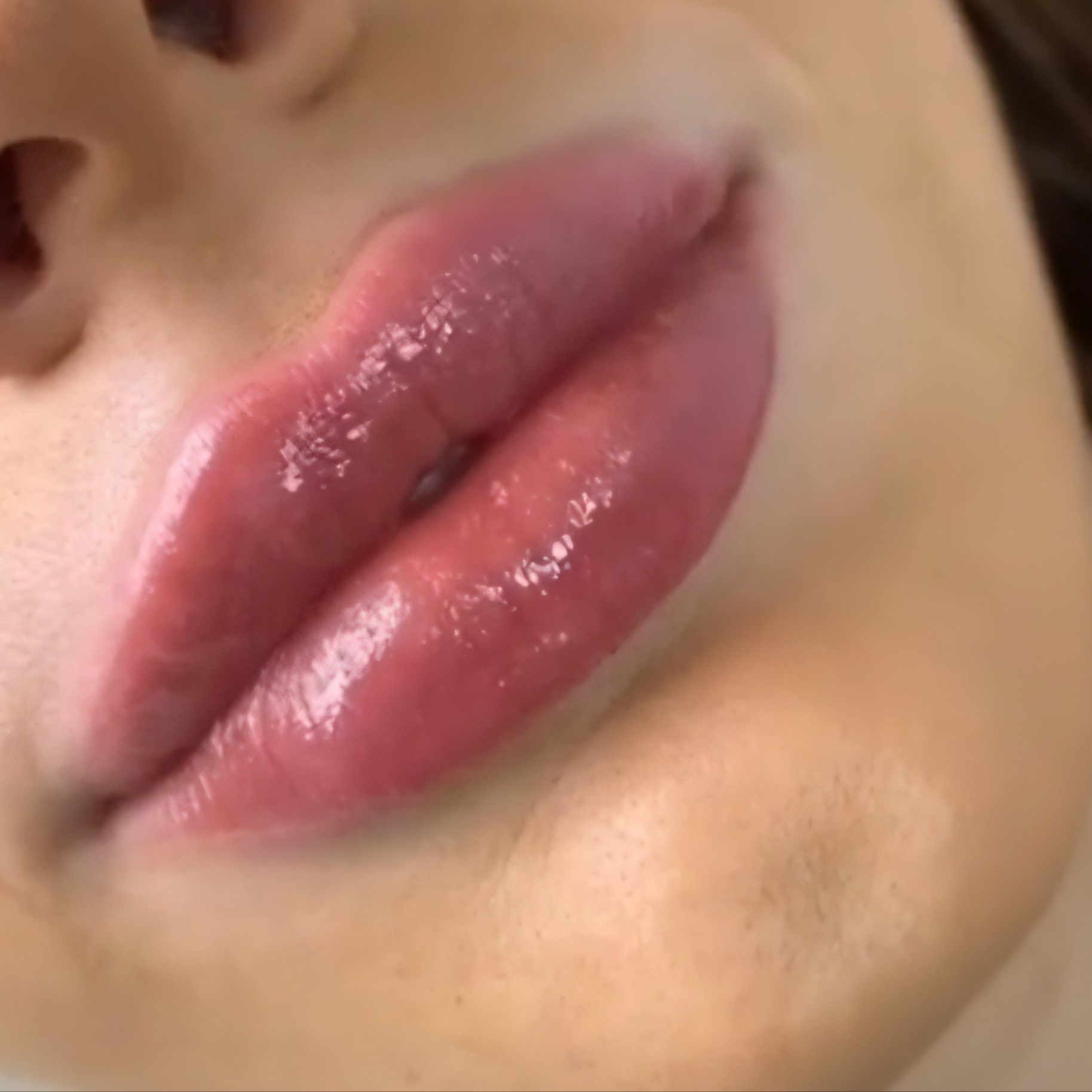 Lip Filler- Full Lip at Glow Lab Aesthetics & Wellness in El Paso, TX