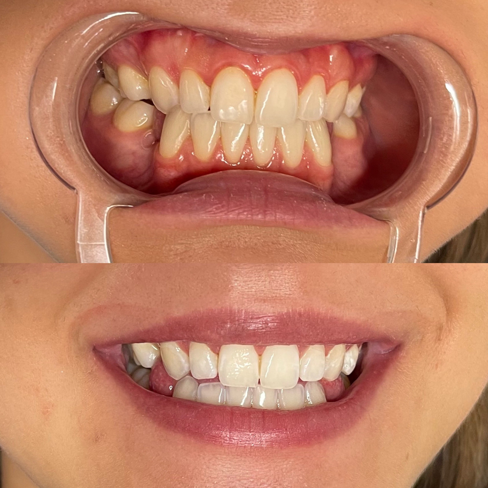 Express Teeth Whitening - 30 Minute