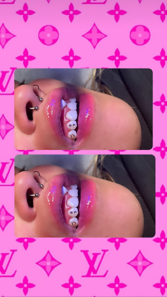 Tooth Gems