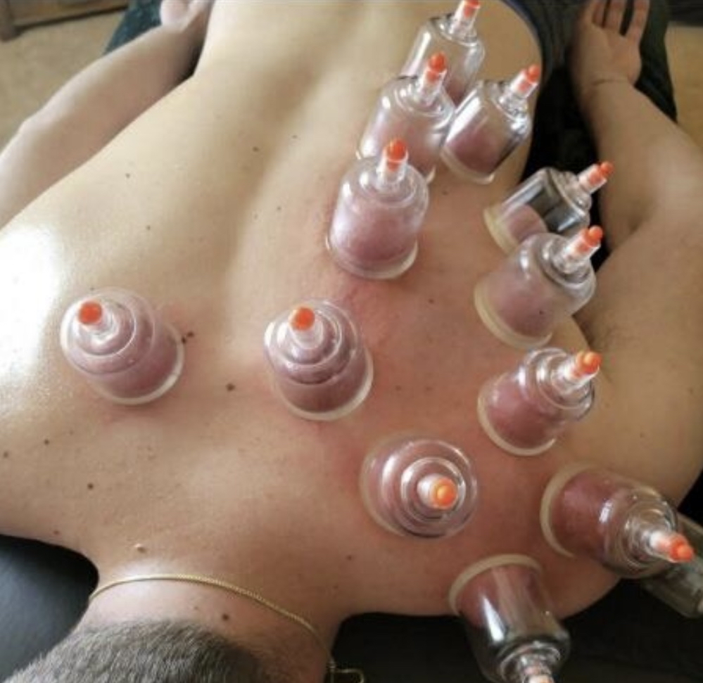 Cupping Therapy