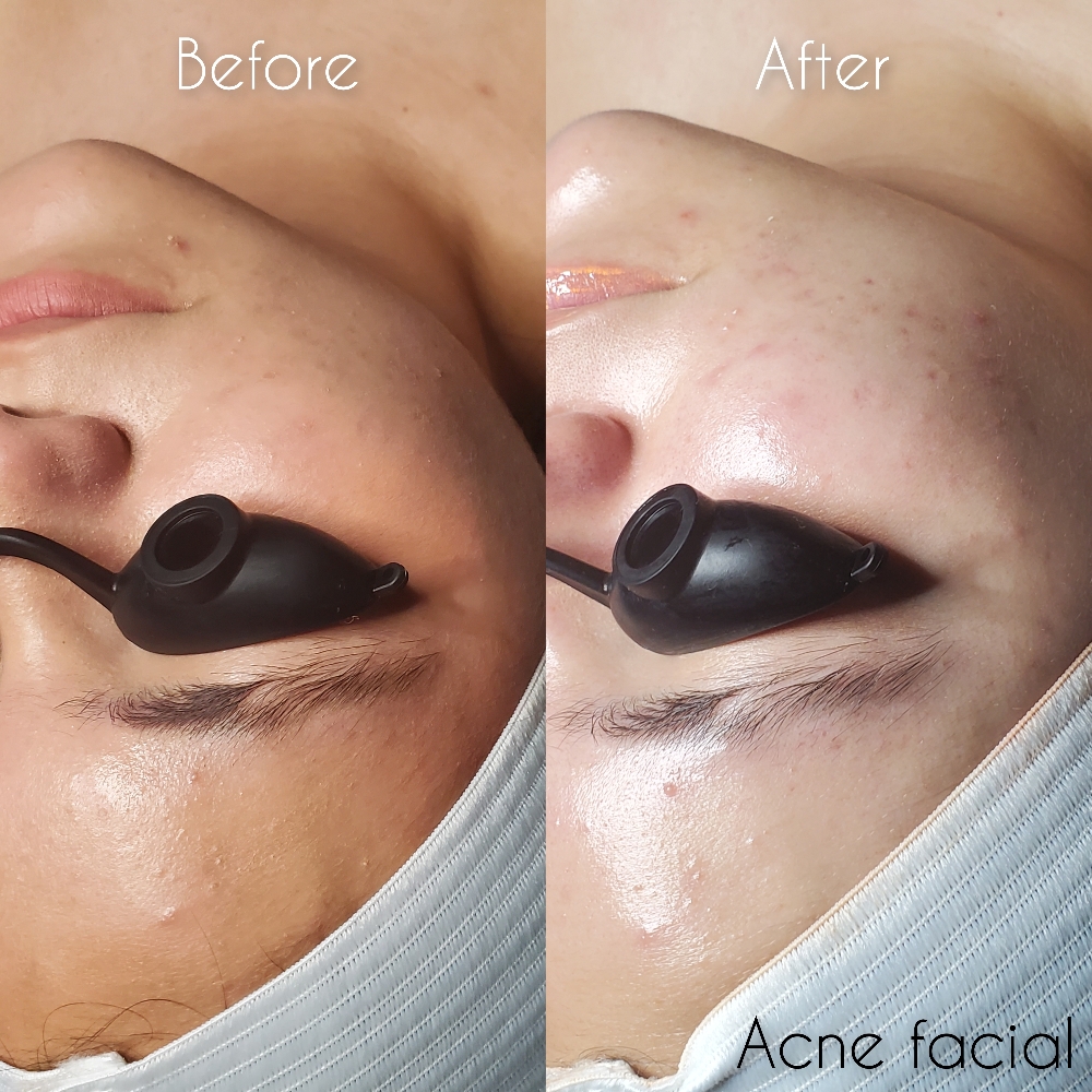 New Client Acne Facial